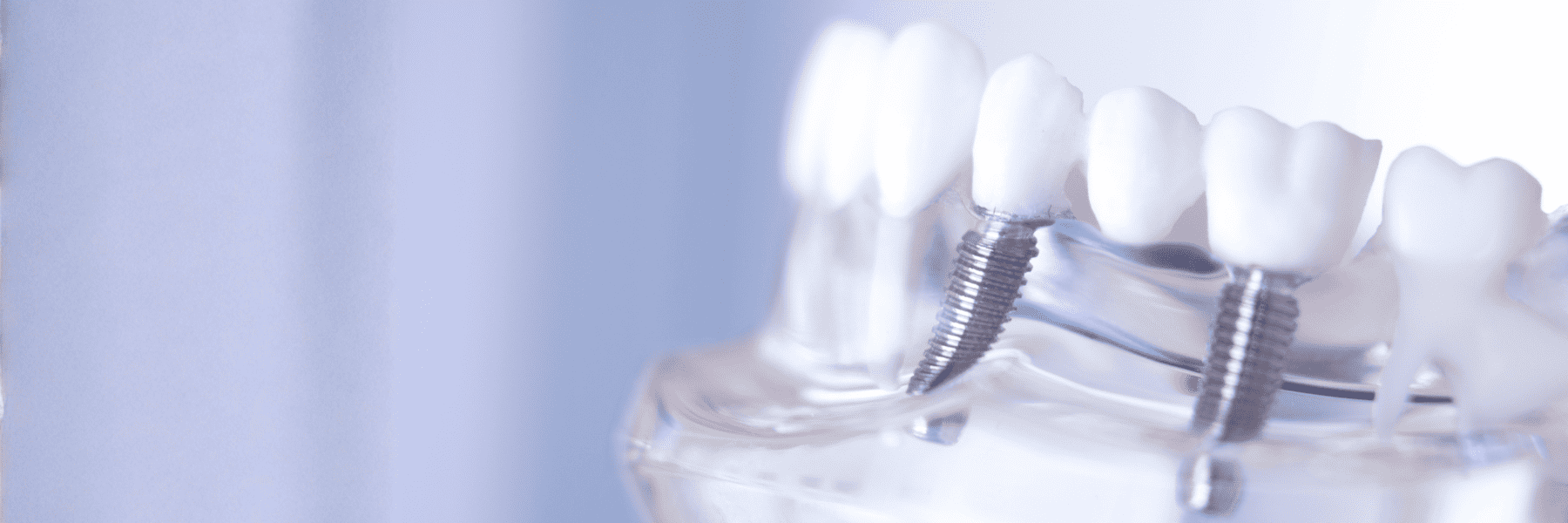 Implant Restorations | Dentist