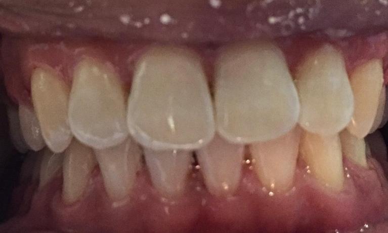 Herndon-Dentist-Cleaning-After-Image