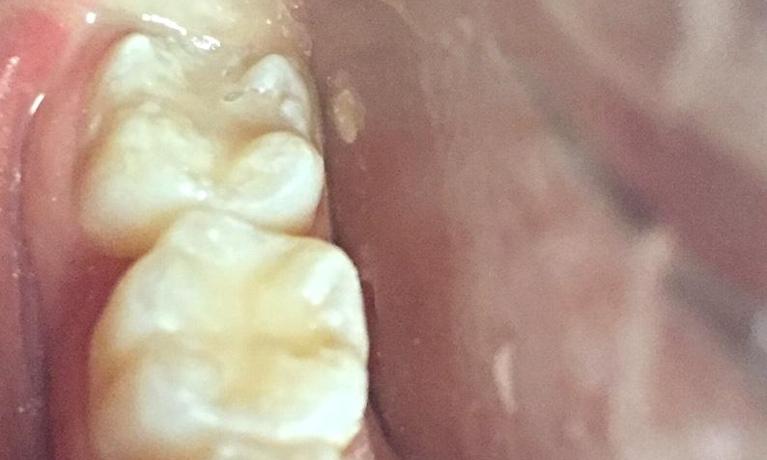 Patient-Fillings-After-Image