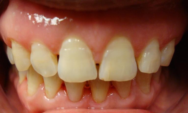 Invisalign-Treatment-After-Image