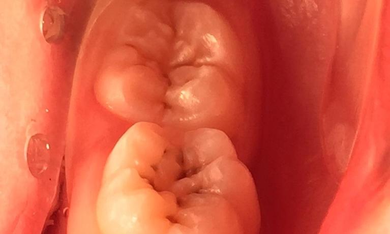 Dental-Fillings-Before-Image