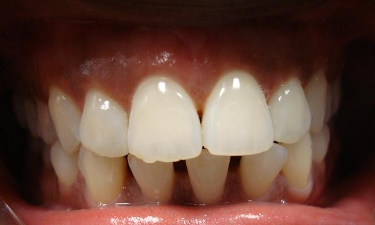 Invisalign-treatment-Before-Image