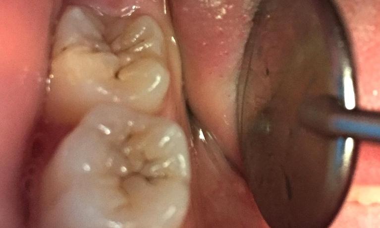 Patient-Fillings-Before-Image